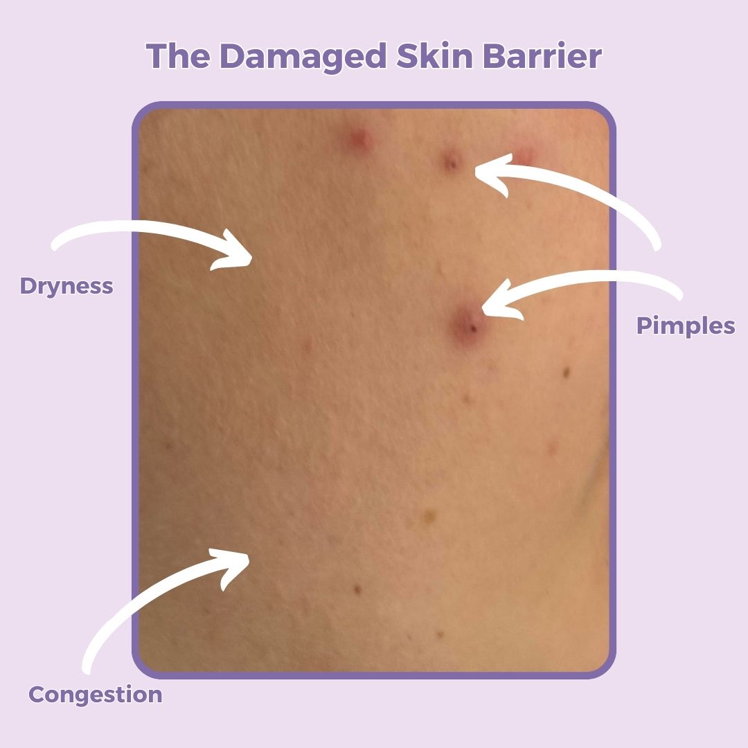 Why Is Protecting Their Skin Barrier So Important?